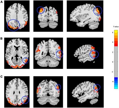 Resting-State Functional MRI Metrics in Patients With Chronic Mild Traumatic Brain Injury and Their Association With Clinical Cognitive Performance